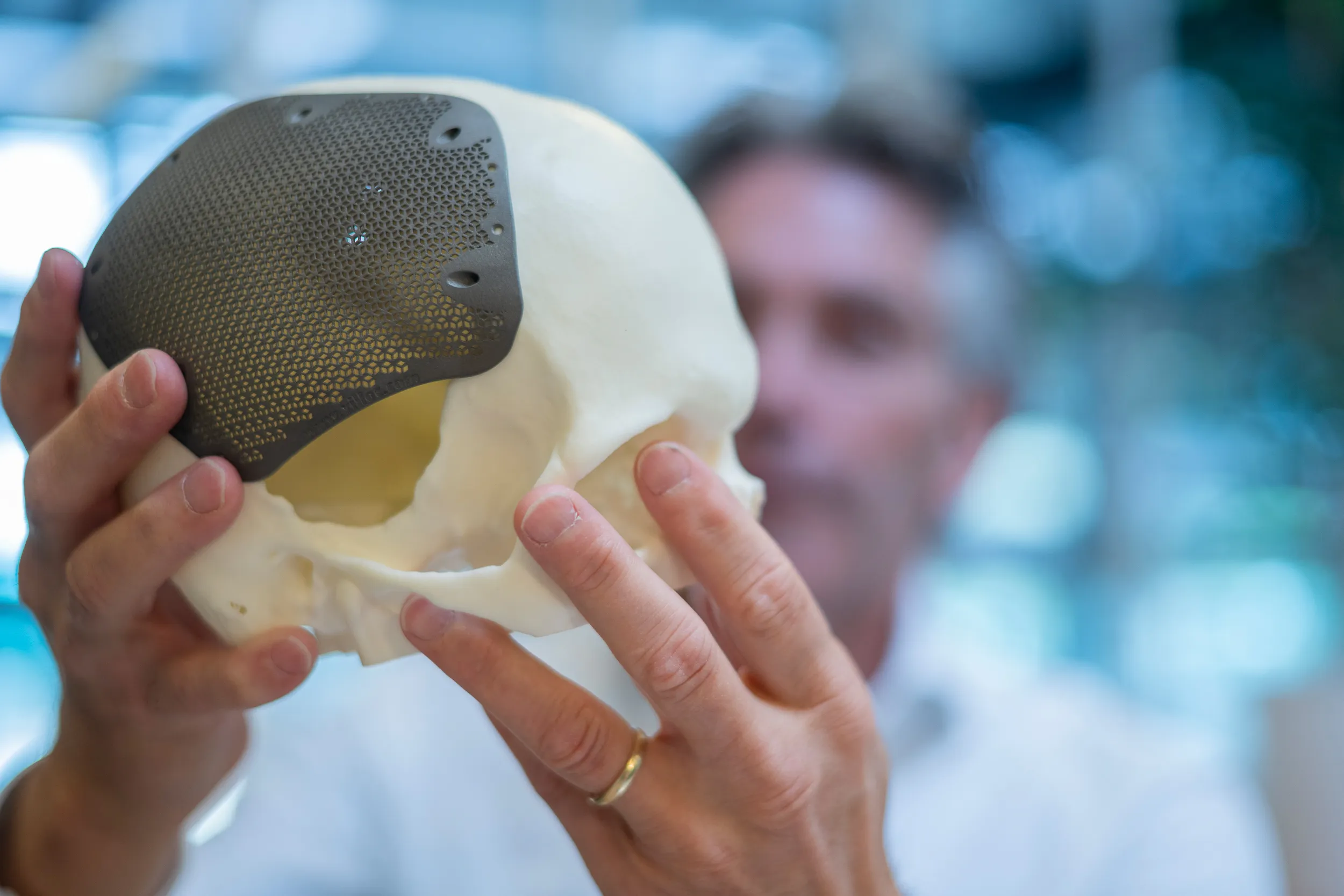 Titanium inlay cranioplasty after ischemic stroke