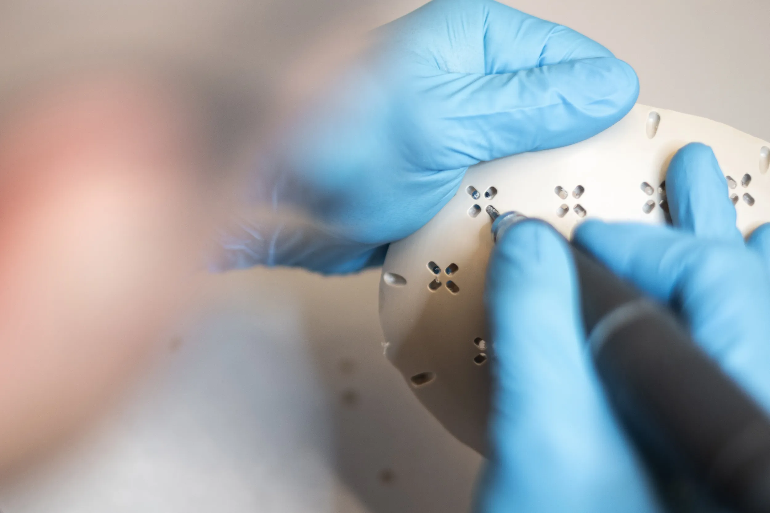 PEEK inlay for fibrous dysplasia-related cranial deformity