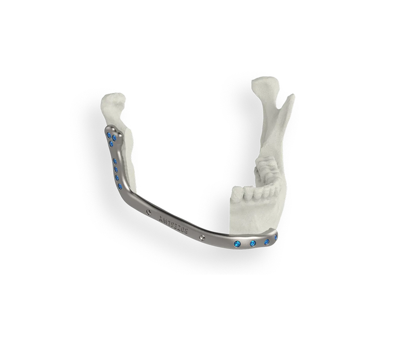 Mandibular Reconstruction
