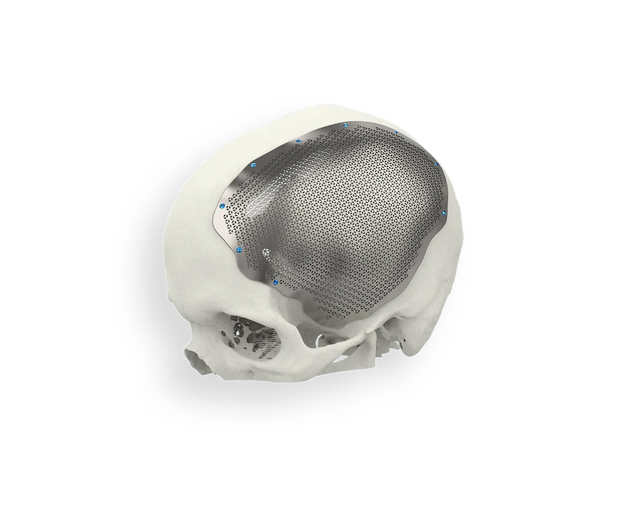 Cranial implant Ti