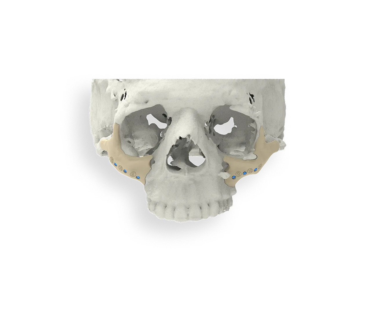 Facial implant
