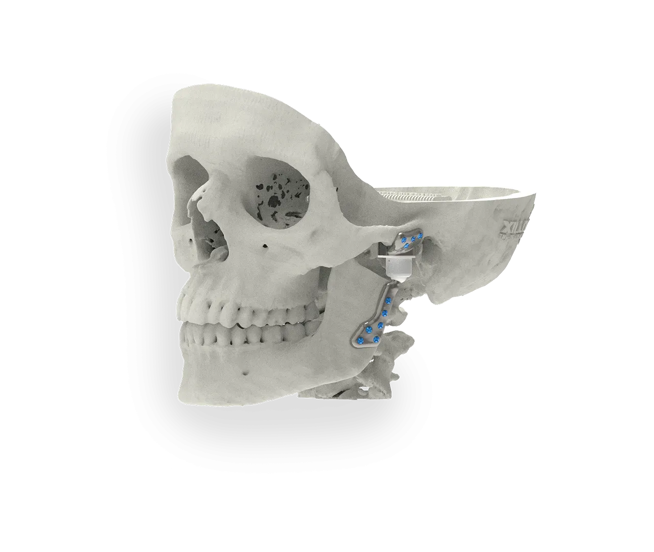 TMJG implant