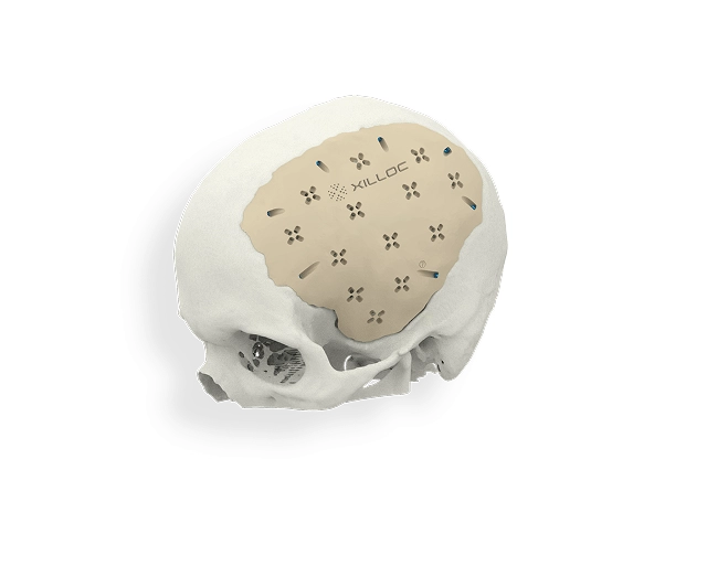 Cranial implant PEEK