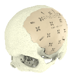 Cranial implant