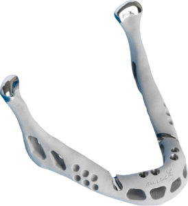 Xilloc Medical Examples PSI Cranioplasty Full Mandibular 3D Jaw Implant Titanium 4