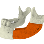Iliac crest for mandible reconstruction