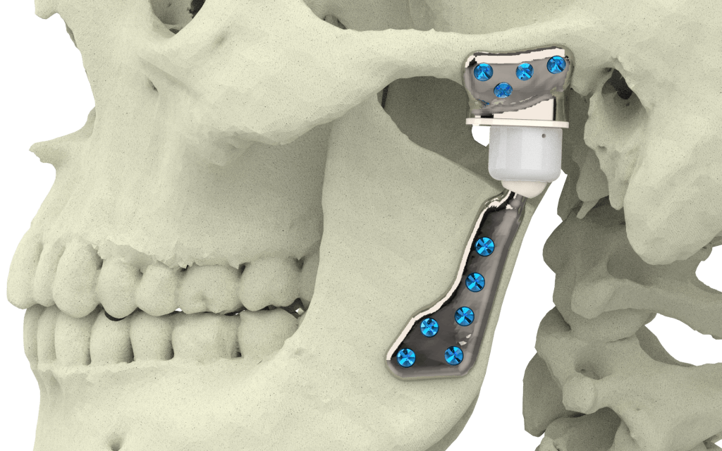 Xilloc Medical B.V. Temporal Mandibular Joint Implant Groningen 1.0