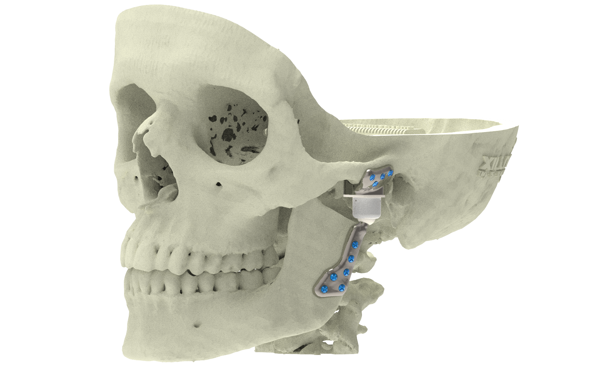 Xilloc Medical B.V. – Temporal Mandibular Joint Implant Groningen