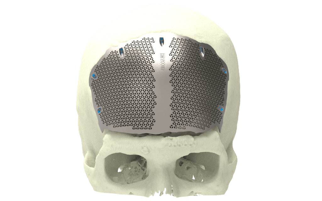 Titan Implant Parts at Mark Miller blog