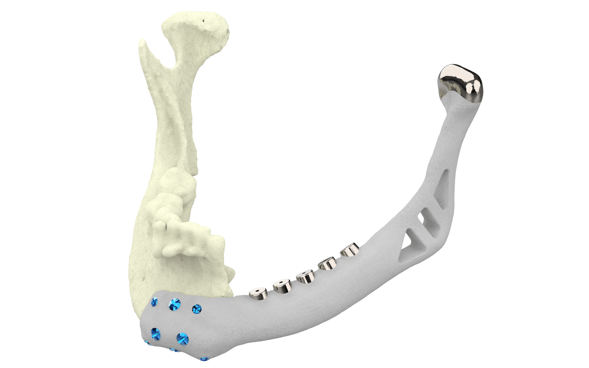 Reconstruction Of The Lateral Mandibular Defect A Rev - vrogue.co